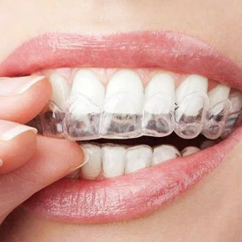 Veneers Vs. Braces: Which Is Right For You?